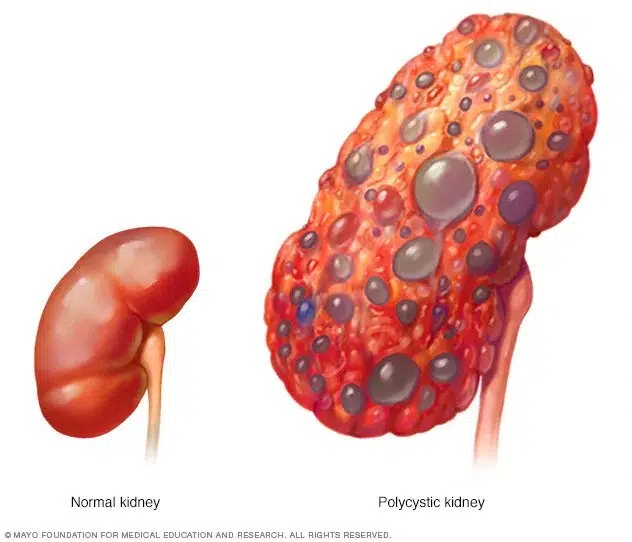 Polycystic Kidney Disease in British Shorthairs